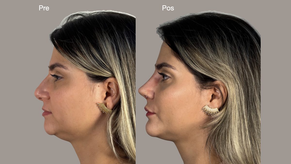 Resultado mentoplastia — perfil