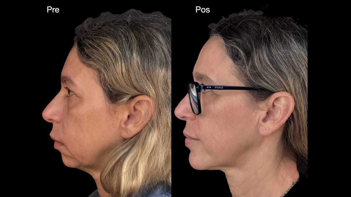 Resultado cirurgia ortognática Kênia — perfil
