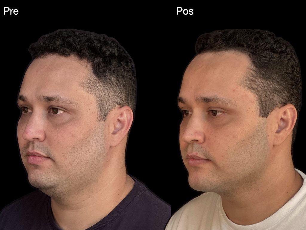 Resultado cirurgia ortognática — perfil masculino