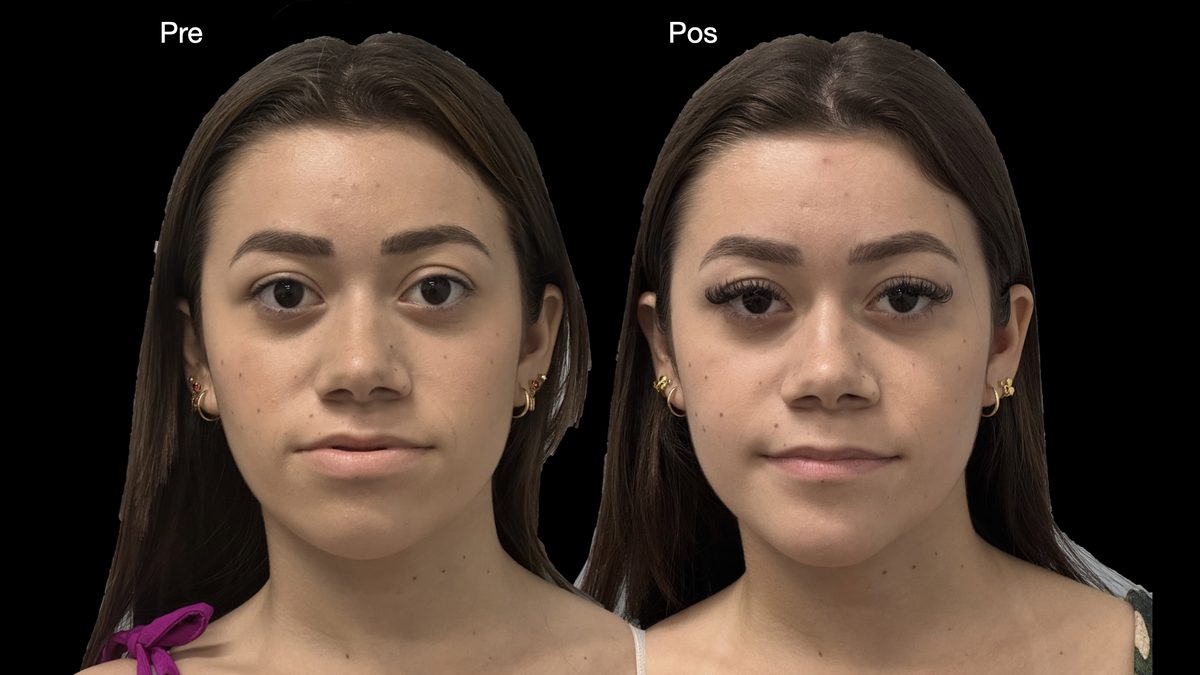Resultado cirurgia ortognática Vitória — frontal