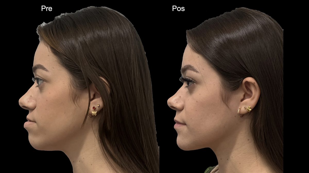 Resultado cirurgia ortognática Vitória — perfil