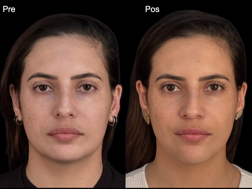 Antes e depois — Cirurgia Ortognática
